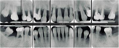 Rare Genetic Disorders Affecting the Periodontal Supporting Tissues in Adolescence